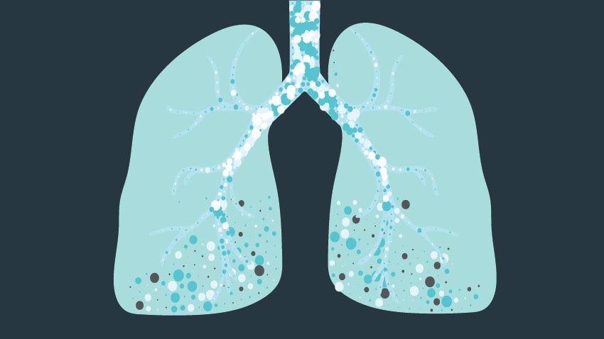 Akciğer sertleşmesi tedavisinde son yıllarda gelişmeler var